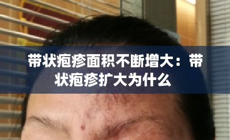 带状疱疹面积不断增大：带状疱疹扩大为什么 
